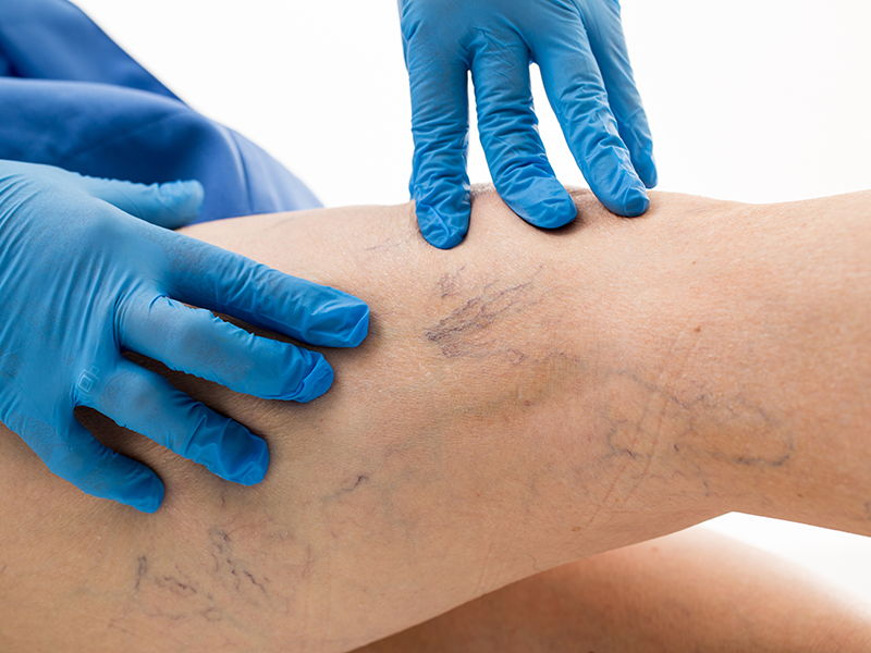 Treatment for Spider Veins & Varicose Veins - Holy Cross Medical Center