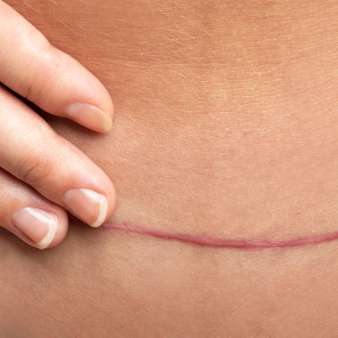 Scarwork/Scar Release Therapy Image for Scarwork/Scar Release Therapy