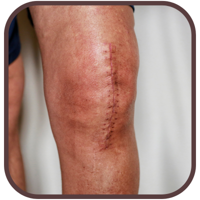 knee with long surgical scar